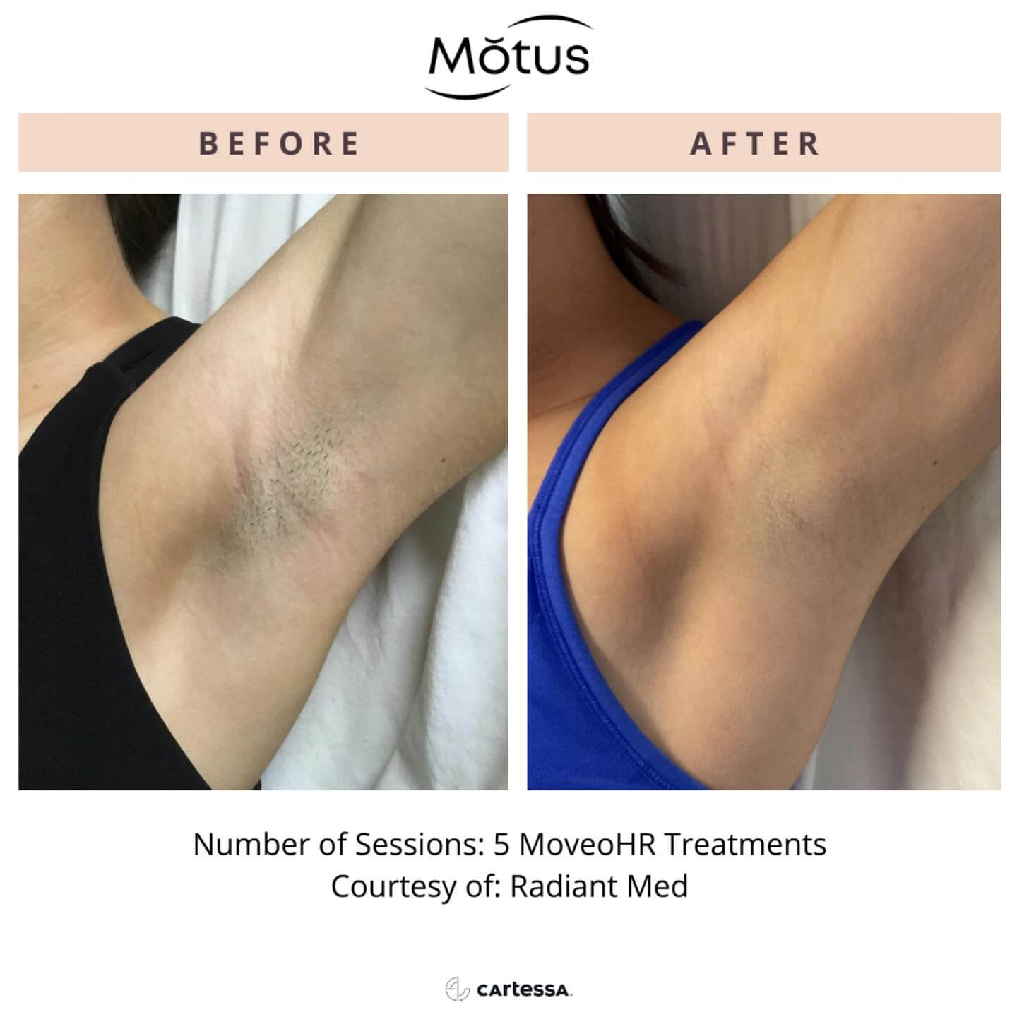 Before and after laser hair removal on underarms showing smoother, hair-free skin with reduced irritation