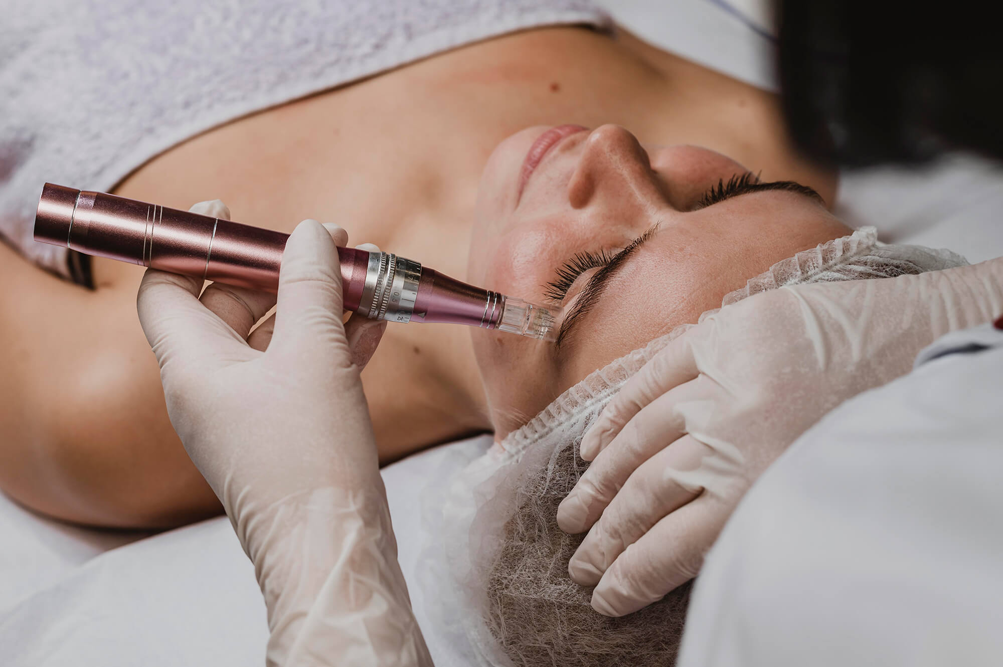 Woman receiving microneedling treatment to boost collagen and reduce fine lines and acne scars